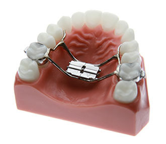 Orthodontic Expander