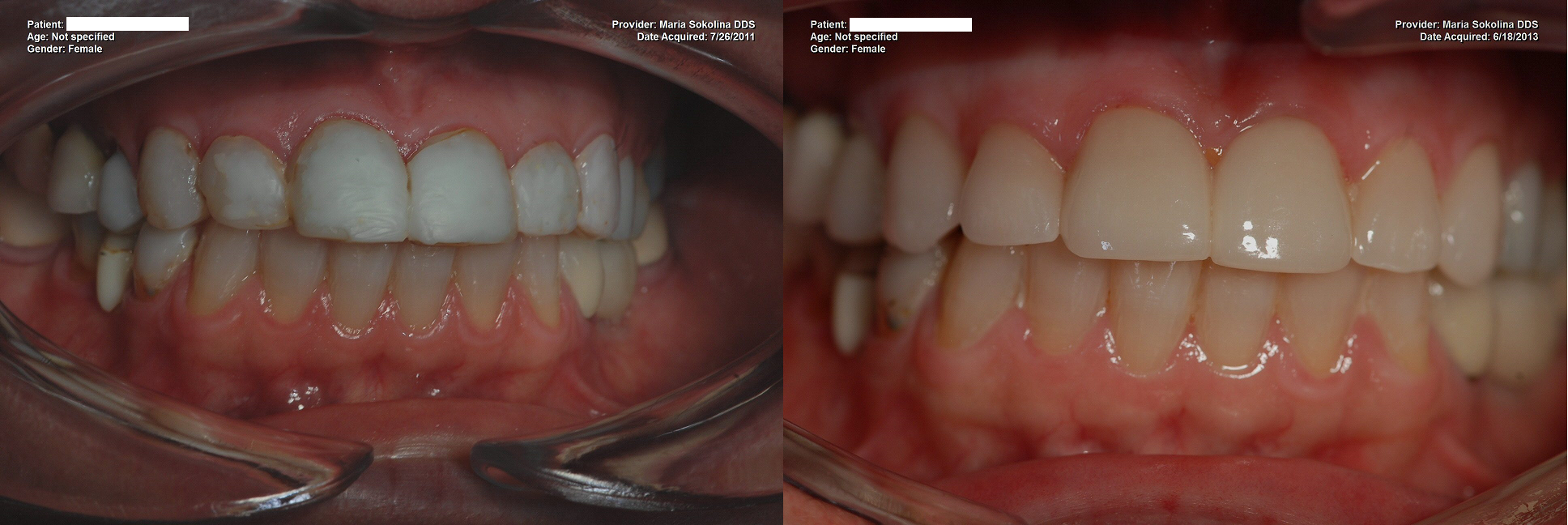 Replacement of composite bonding with porcelain veneers