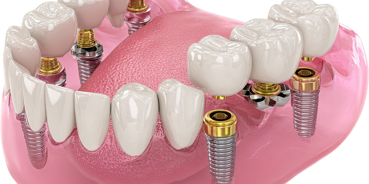 What-is-All-On-4-Dental-