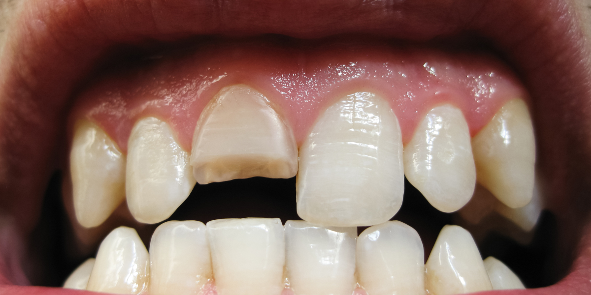 Cracked Tooth But No Pain - Feature image