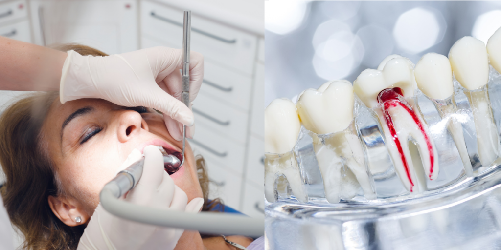 Still Sore After a Filling_ Why It Might Be Root Canal Time