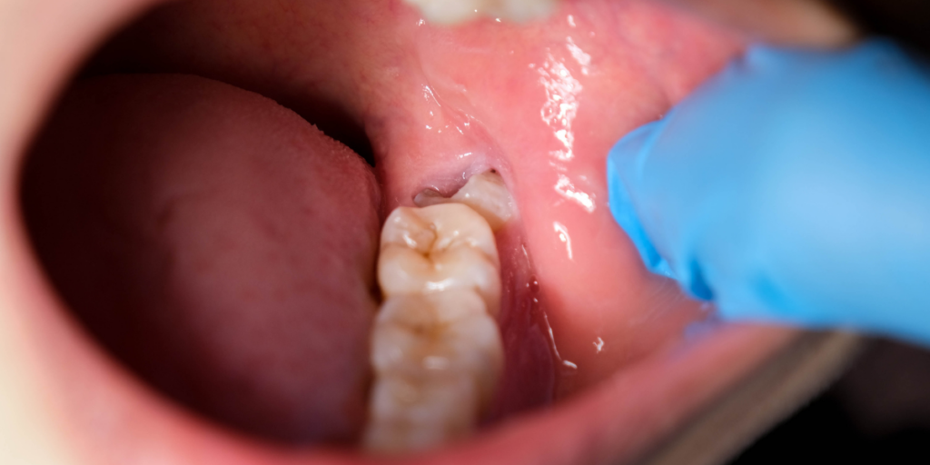 The Most Common Hidden Risks of Painless Wisdom Teeth