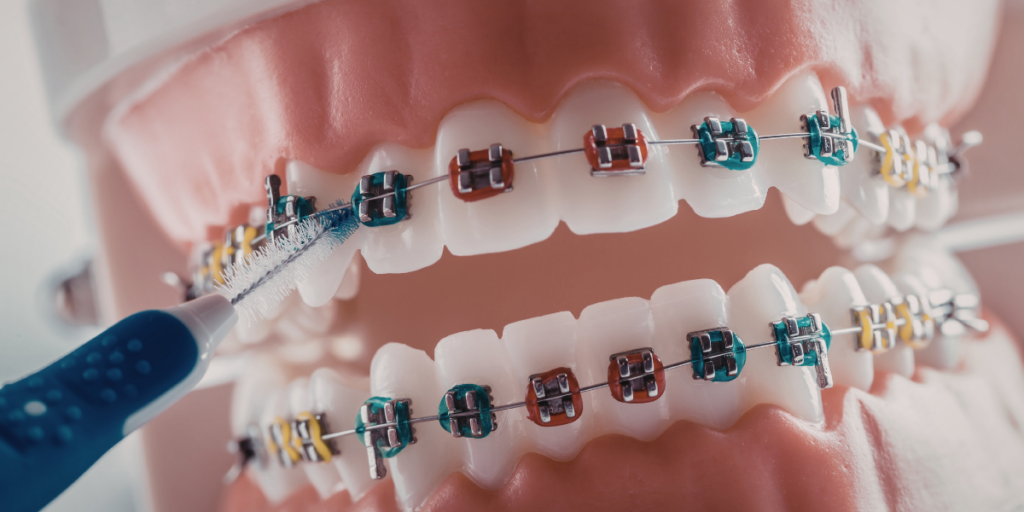 WHY CHOOSE US_ - braces