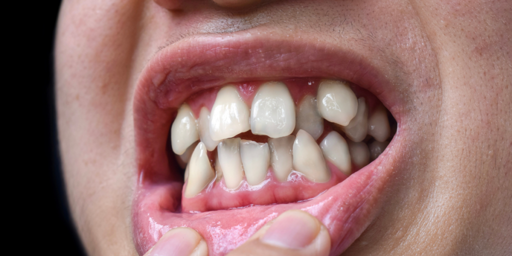 Why Preventive Wisdom Teeth Removal Is Often Recommended