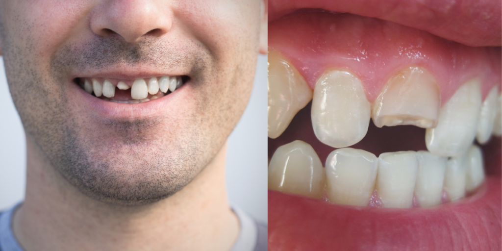 Types of Tooth Cracks That Often Go Unnoticed