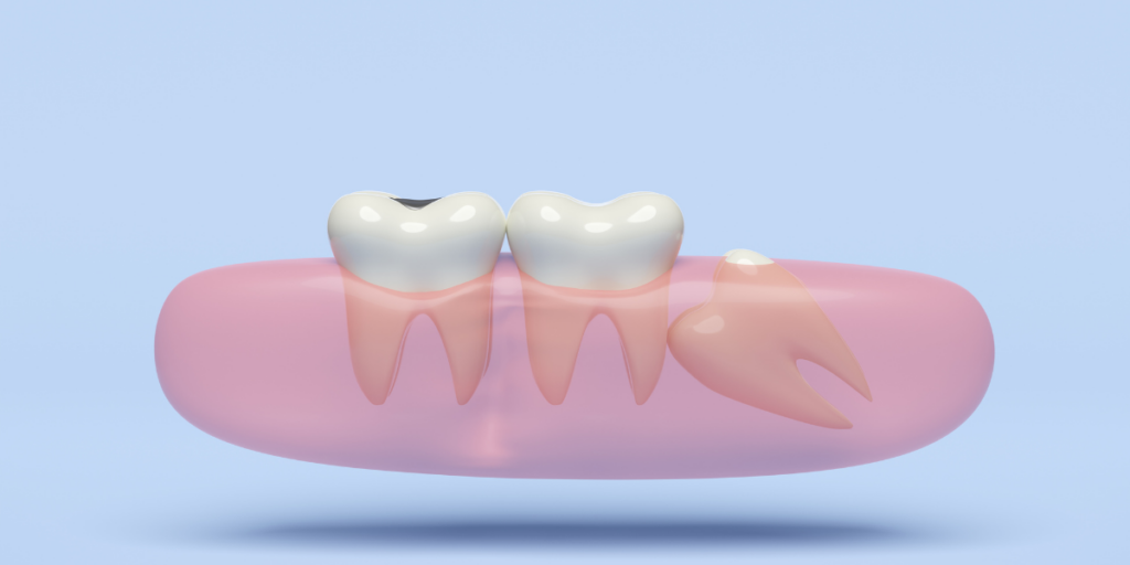 Red Flags That Suggest Wisdom Teeth Should Be Removed