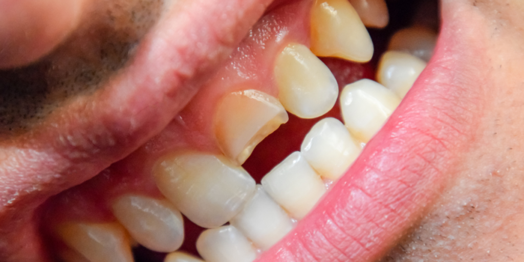 How We Treat Cracked Teeth at Harmony Dental Arts