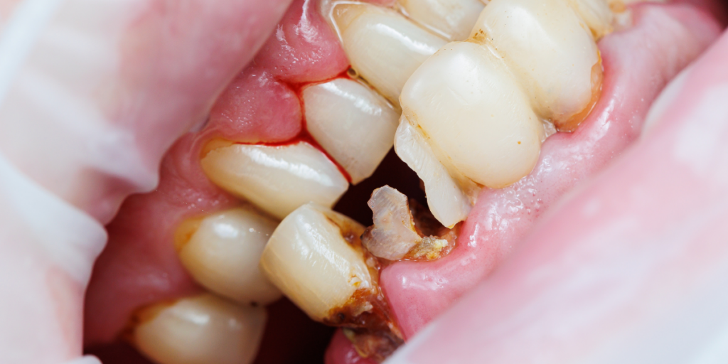 What Happens During a Cracked Tooth Evaluation in Clifton