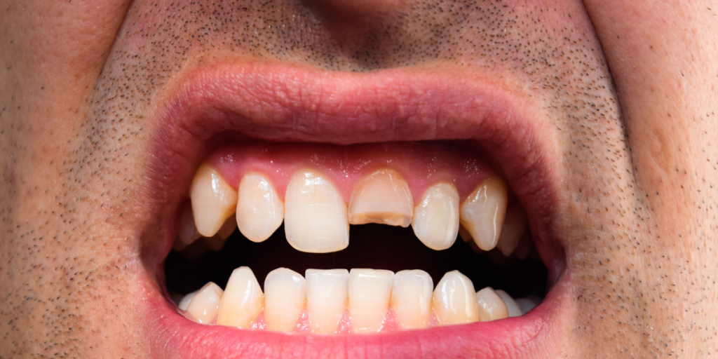 Common Causes of Cracked Teeth 