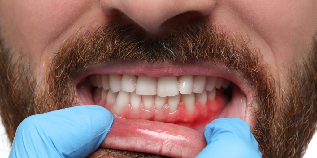 What Is a Dental Abscess and Why Is It Considered a Dental Emergency
