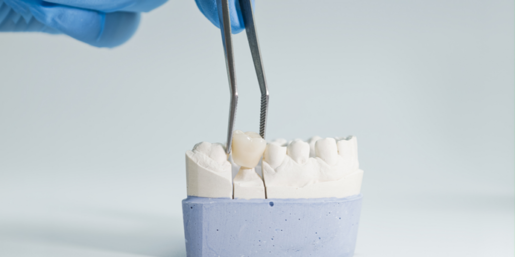 Dental Crown Placement In Clifton — What To Expect