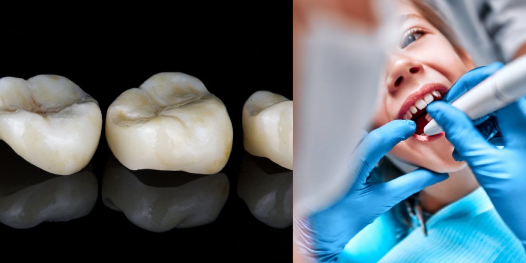 Does a Cracked Tooth Always Need a Crown? (When It Might Not)