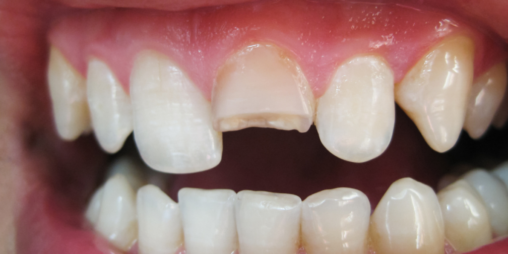 Why A Cracked Tooth Can Be Serious Even If It Doesn’t Hurt