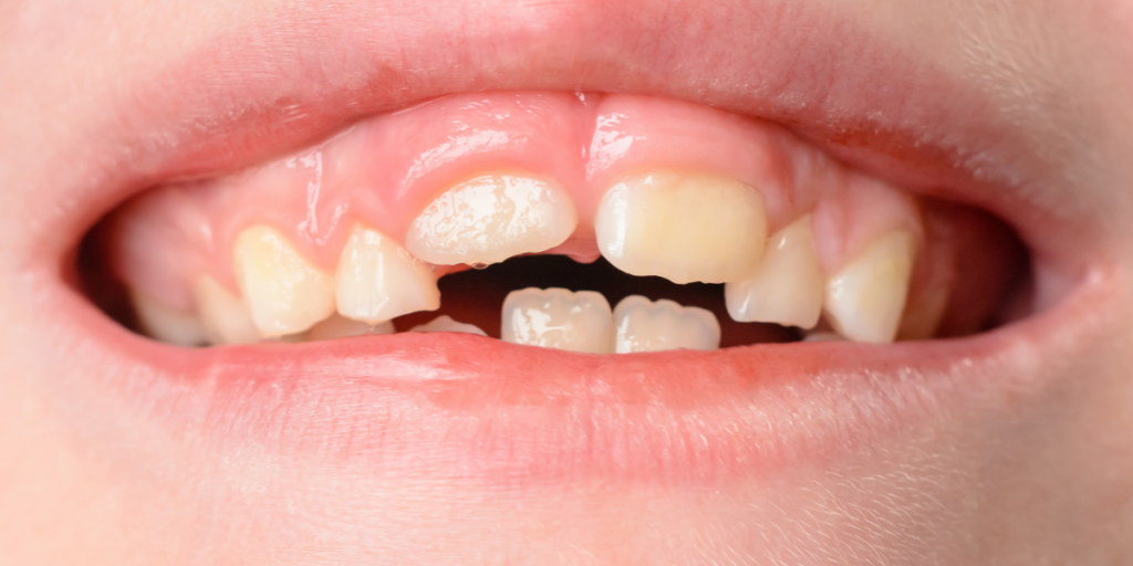 What Happens If You Ignore a Cracked Tooth Without Pain?