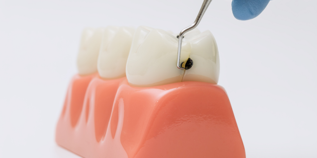Can Cavities Happen Even With Good Oral Hygiene?