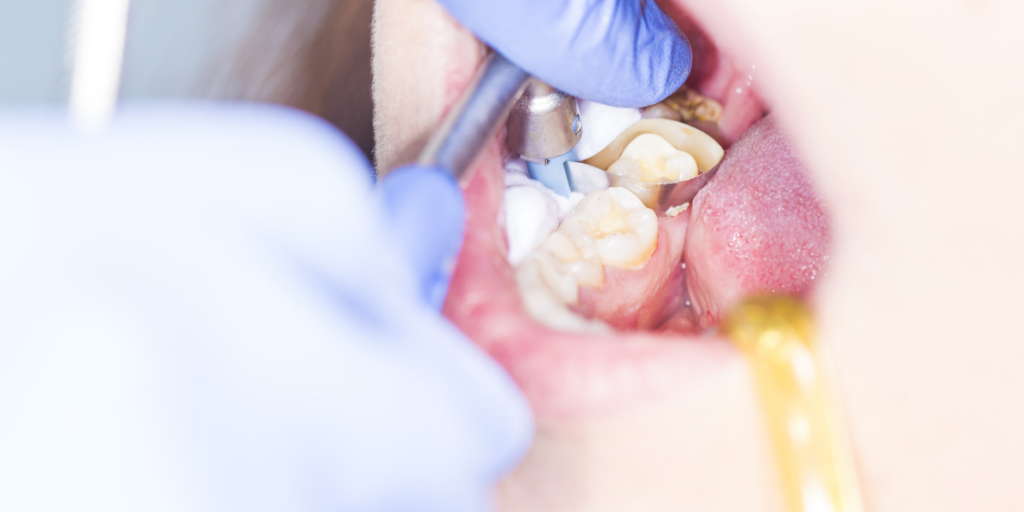 Cavity Prevention In Clifton: What Actually Works For High-Risk Patients