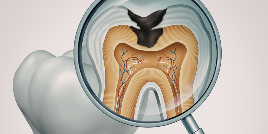 Genetics And Tooth Structure: Why Some People Get Cavities More Easily