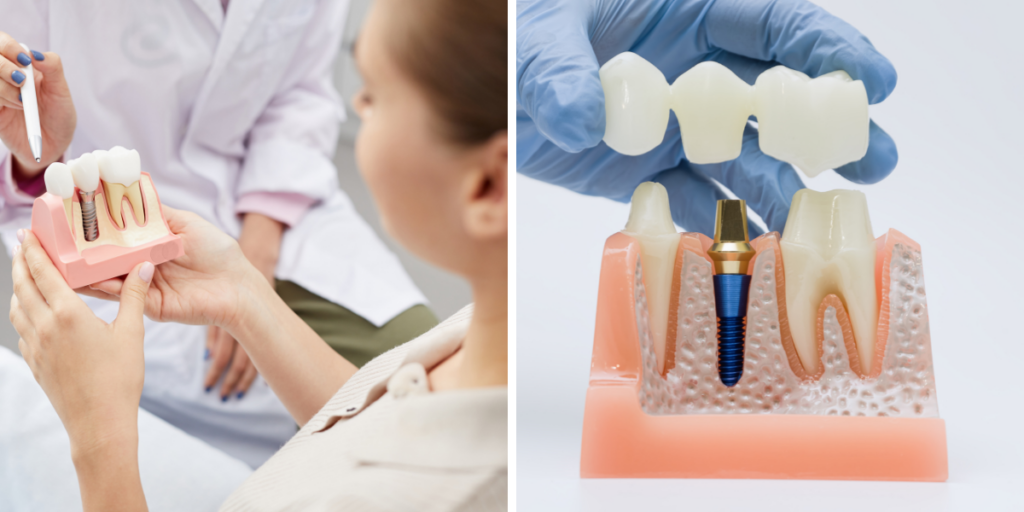 How a Clifton Dentist Decides Between a Filling, Crown, or Implant, Not What You Think
