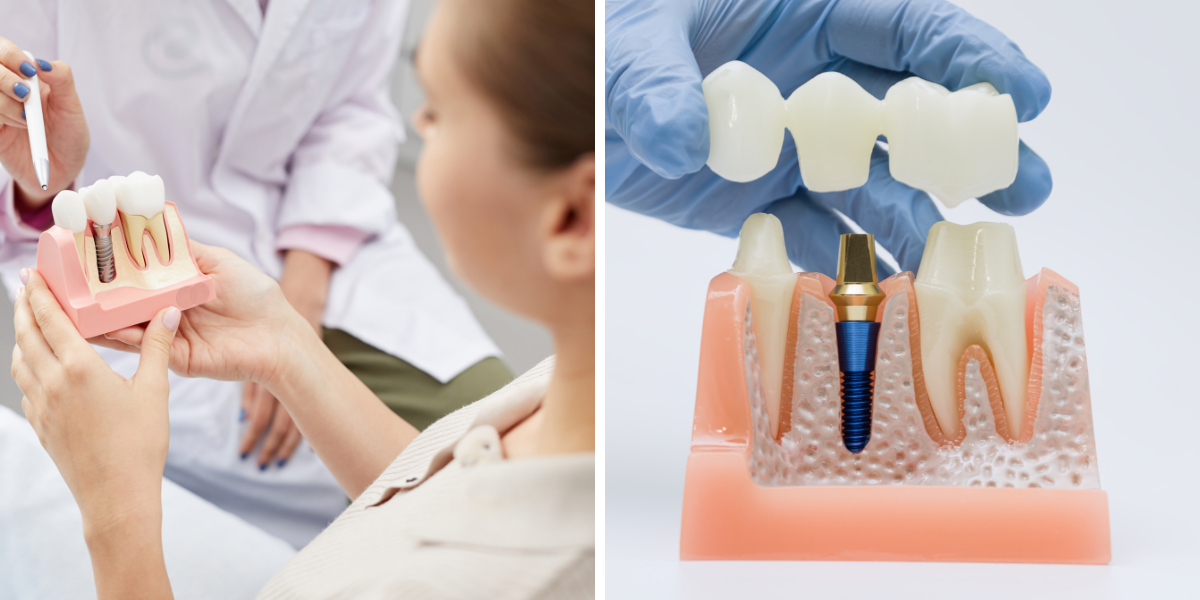 How a Clifton Dentist Decides Between a Filling, Crown, or Implant, Not What You Think