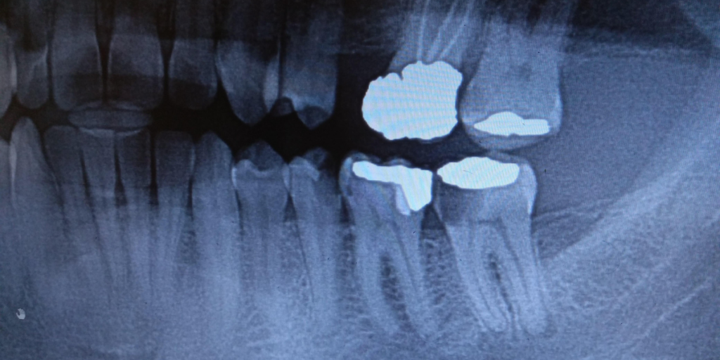 Oral Microbiome: When Cavity-Causing Bacteria Thrive Despite Good Habits