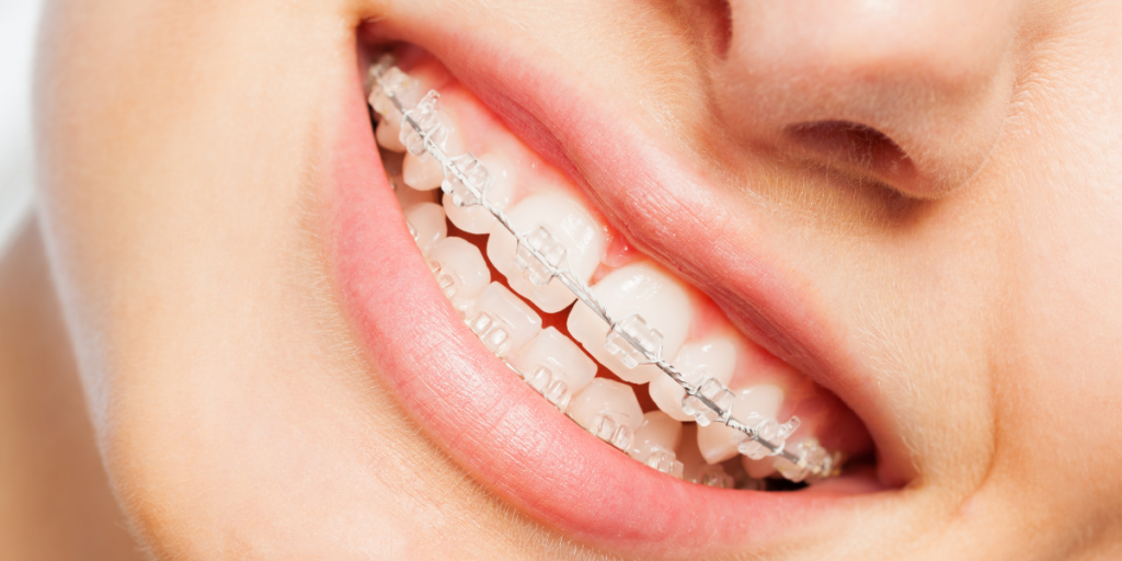 WHY CHOOSE US Clear Braces