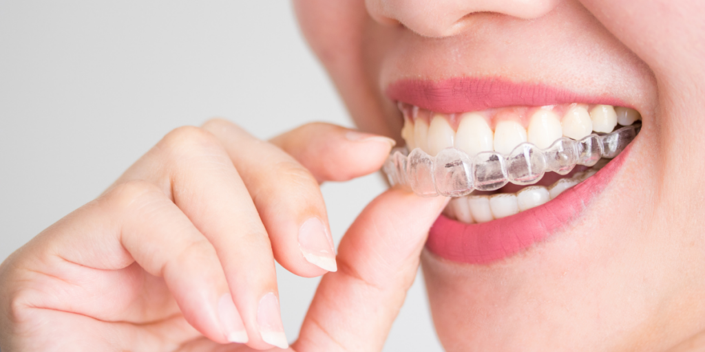 What Happens If You Skip Retainers After Invisalign?