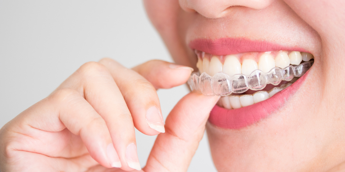 What Happens If You Skip Retainers After Invisalign?