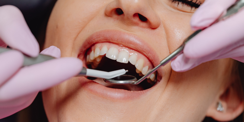 Can Professional Dental Cleaning Improve Bad Breath That Mouthwash Can’t Fix?