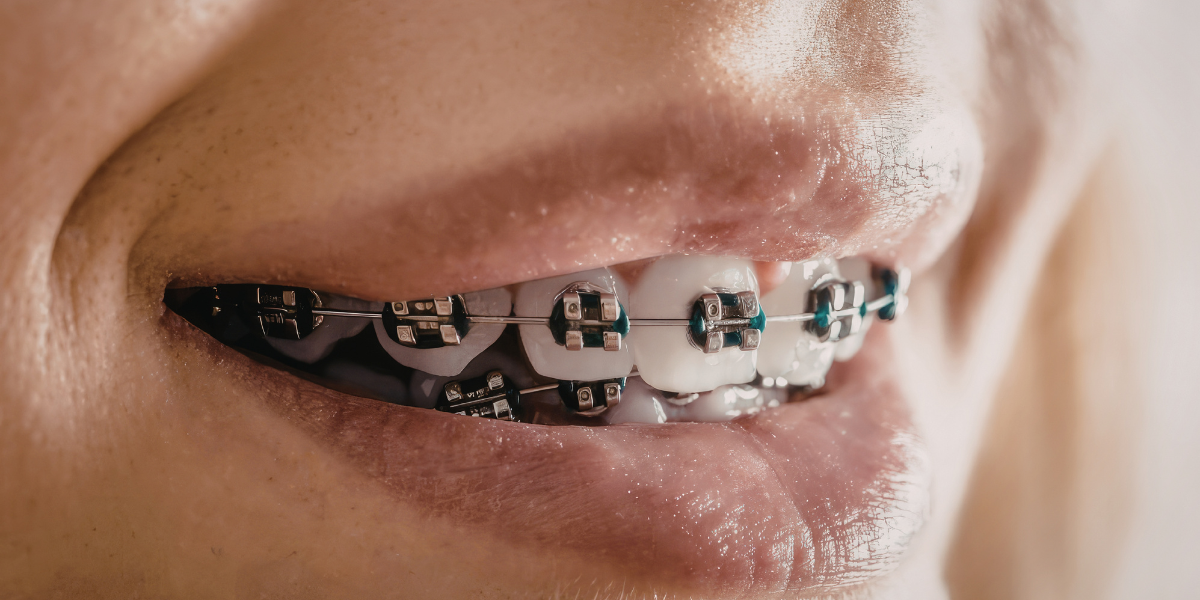 Loose Bracket or Wire: What You Should Do Immediately