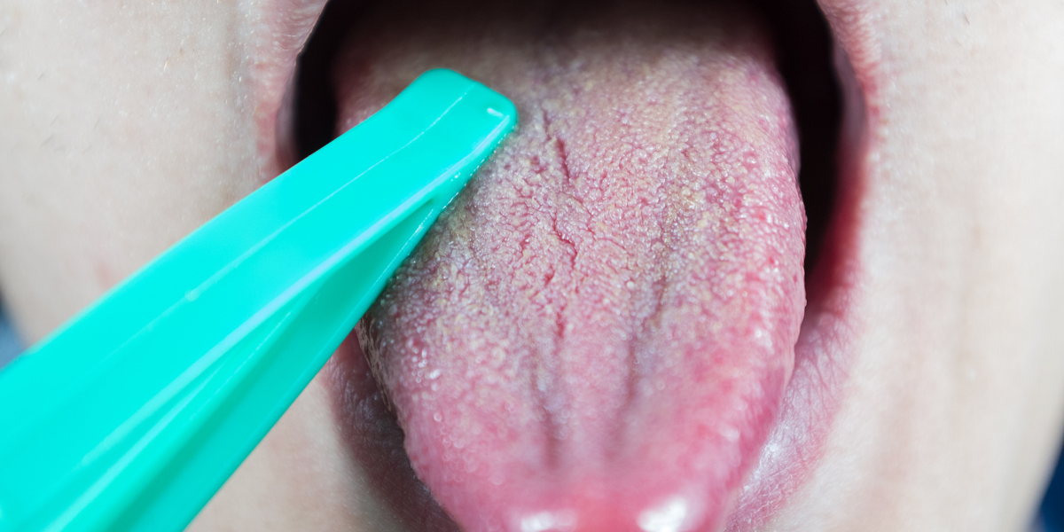 Solutions and Management for Tongue Thrust
