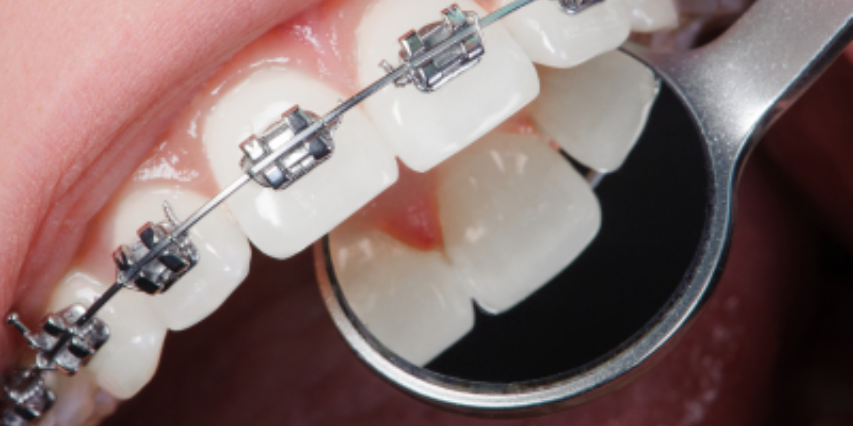 What Happens If You Stop Orthodontic Treatment Midway?