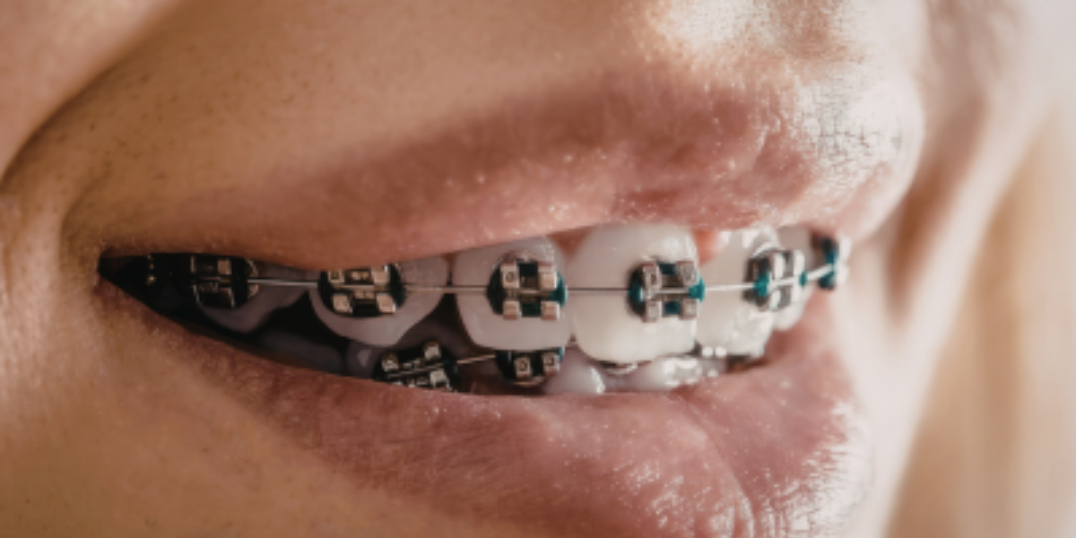 How To Avoid Interrupting Your Orthodontic Care
