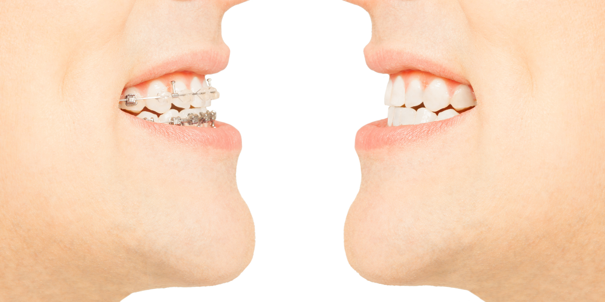 Overbite Problems in Clifton & How Orthodontic Treatment Fixes It
