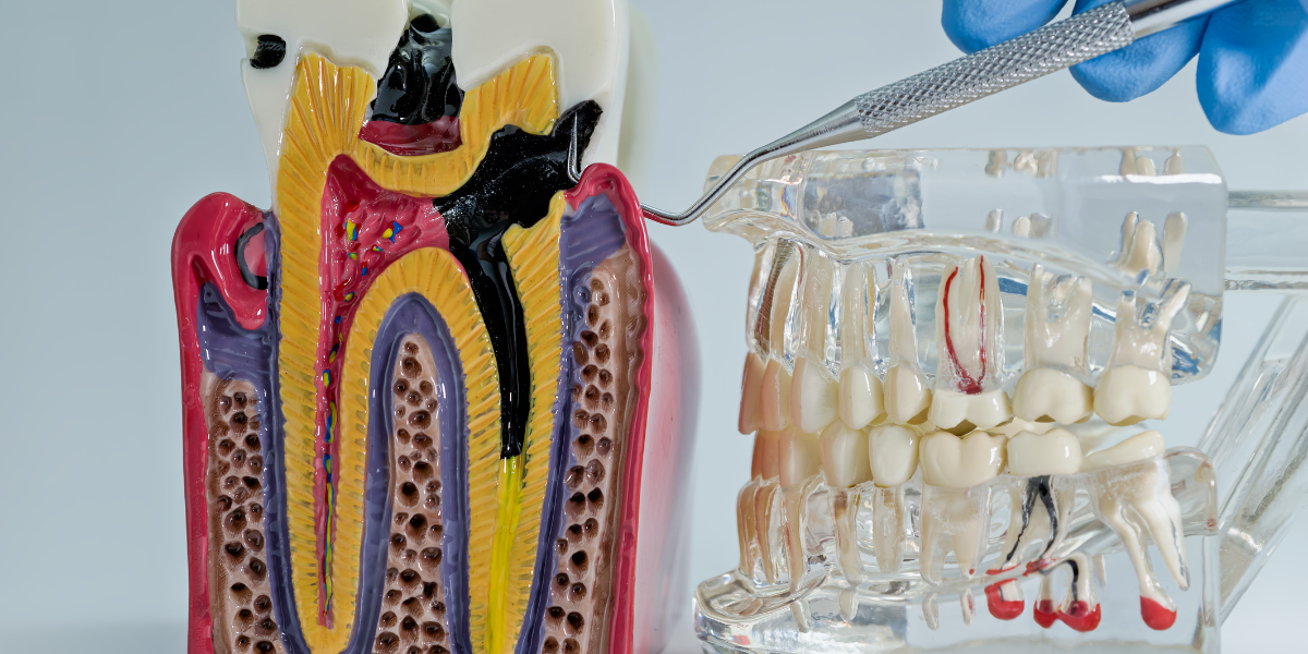 Root Canal Cost in Clifton + When You Actually Need One