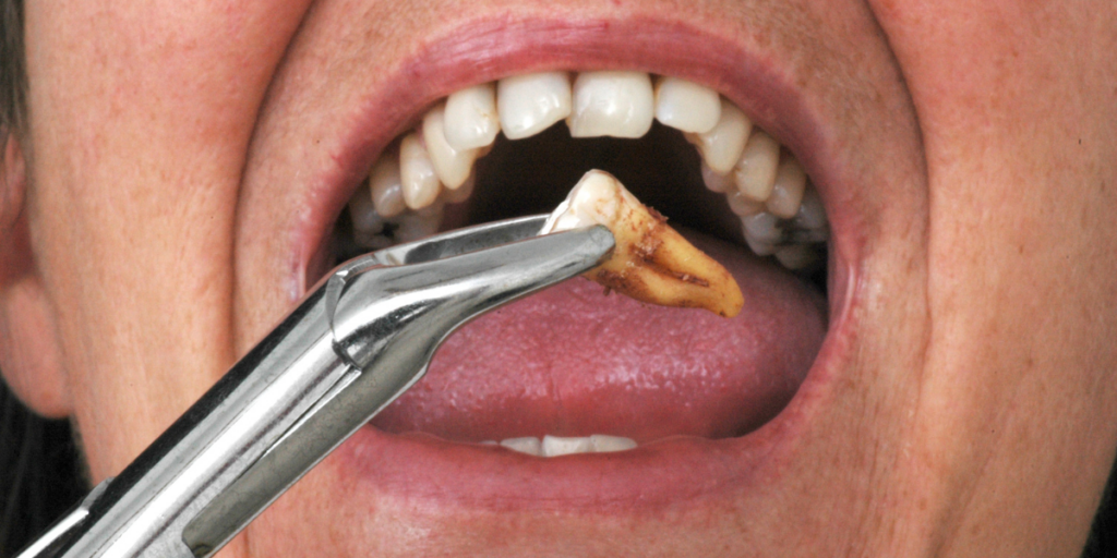 Tooth Broke While Eating? What Clifton Patients Should Do Immediately