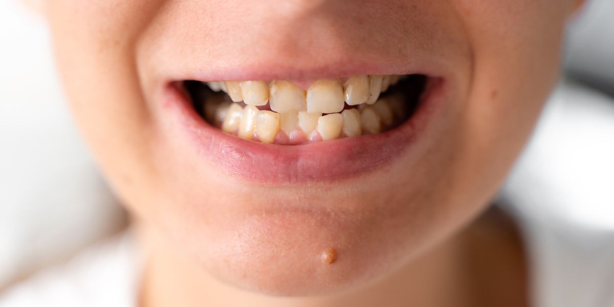 Untreated Bite Issues & How They Affect Your Oral Health