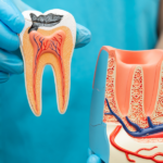 What Is a Root Canal and Why Do Dentists Recommend It