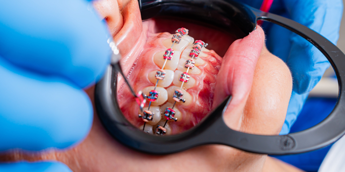 Orthodontic Treatment Options for Overbite Correction in Clifton