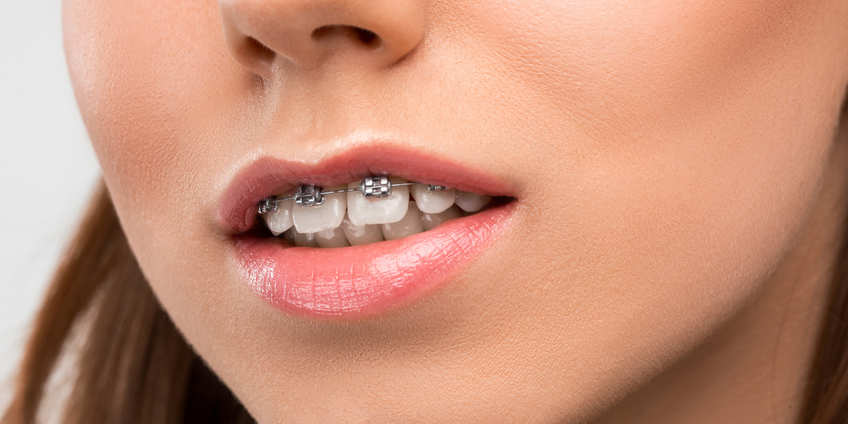 Understanding Overbite Problems and Why They Matter