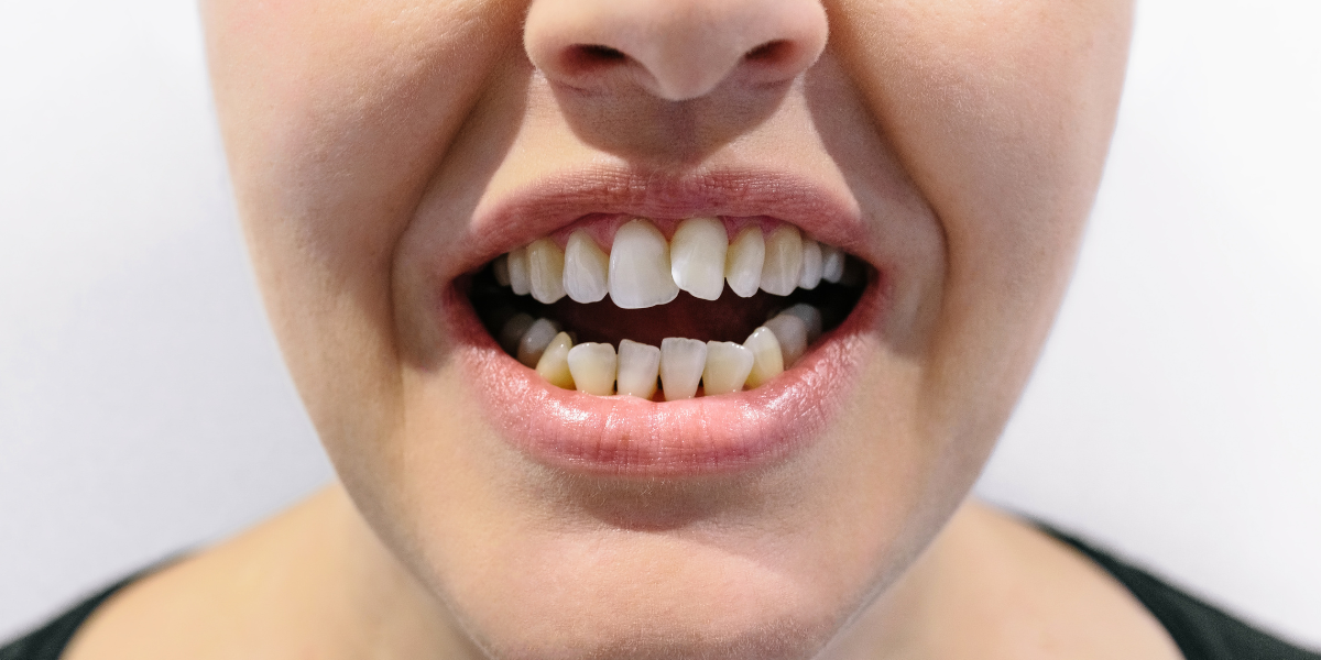 Why Bite Problems Often Get Worse Over Time
