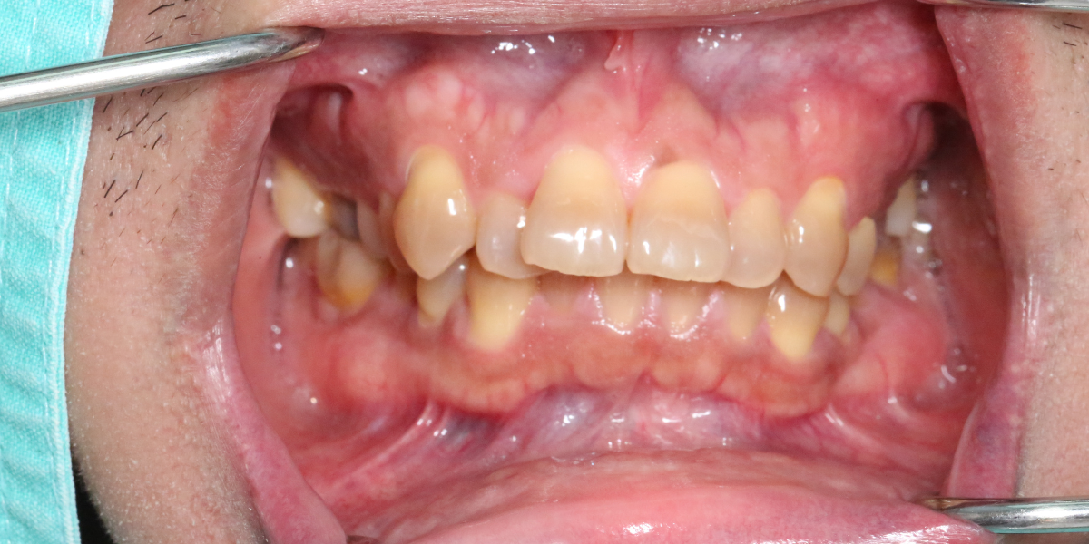 What Are Bite Issues?