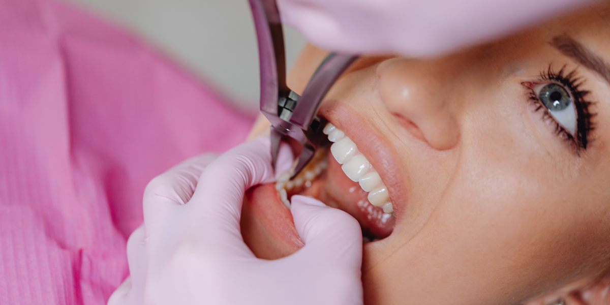 Emergency Treatment Options for a Broken Tooth
