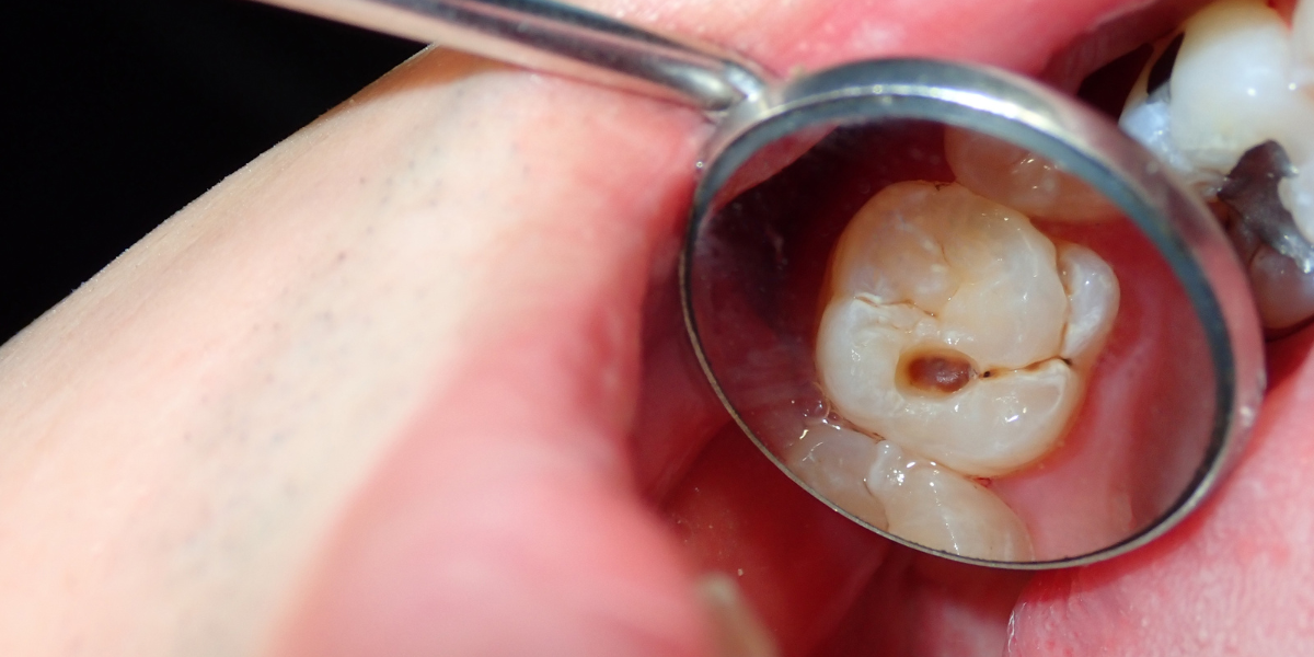 Common Reasons Teeth Break While Eating
