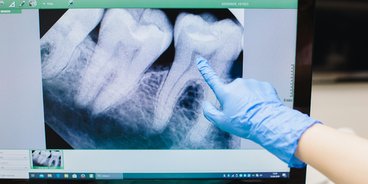 What To Avoid After Breaking a Tooth
