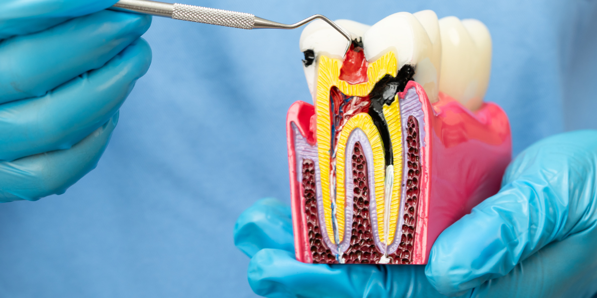 Root Canal Cost With Insurance in Clifton

