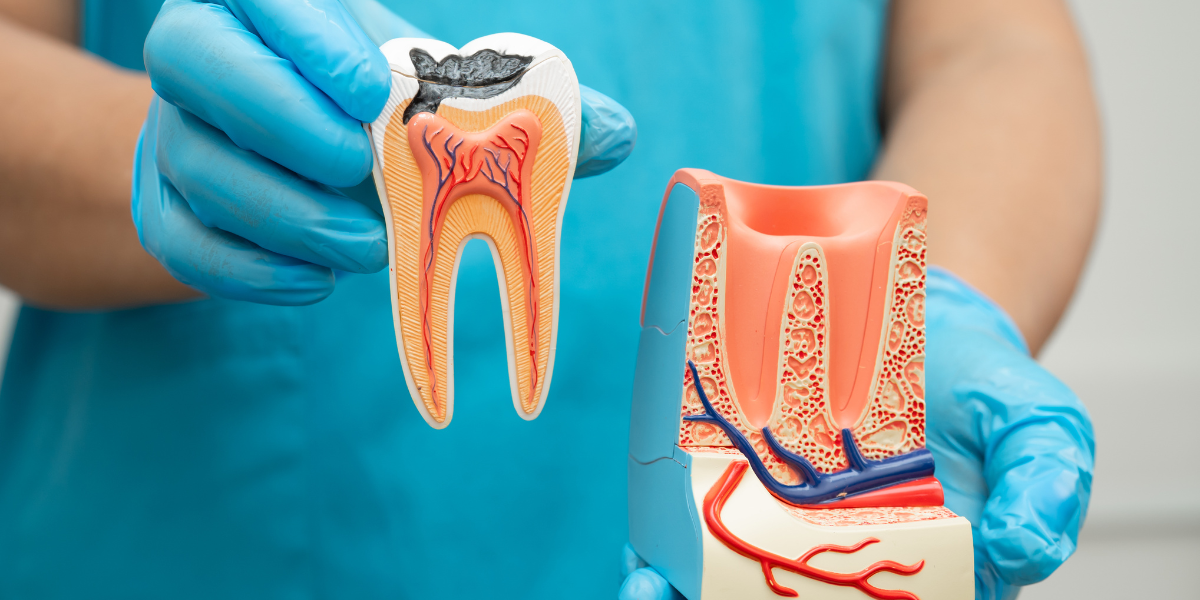 What Is a Root Canal and Why Do Dentists Recommend It?
