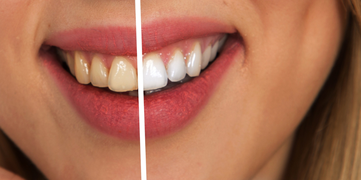 Why Safe Teeth Whitening Starts With Enamel Protection