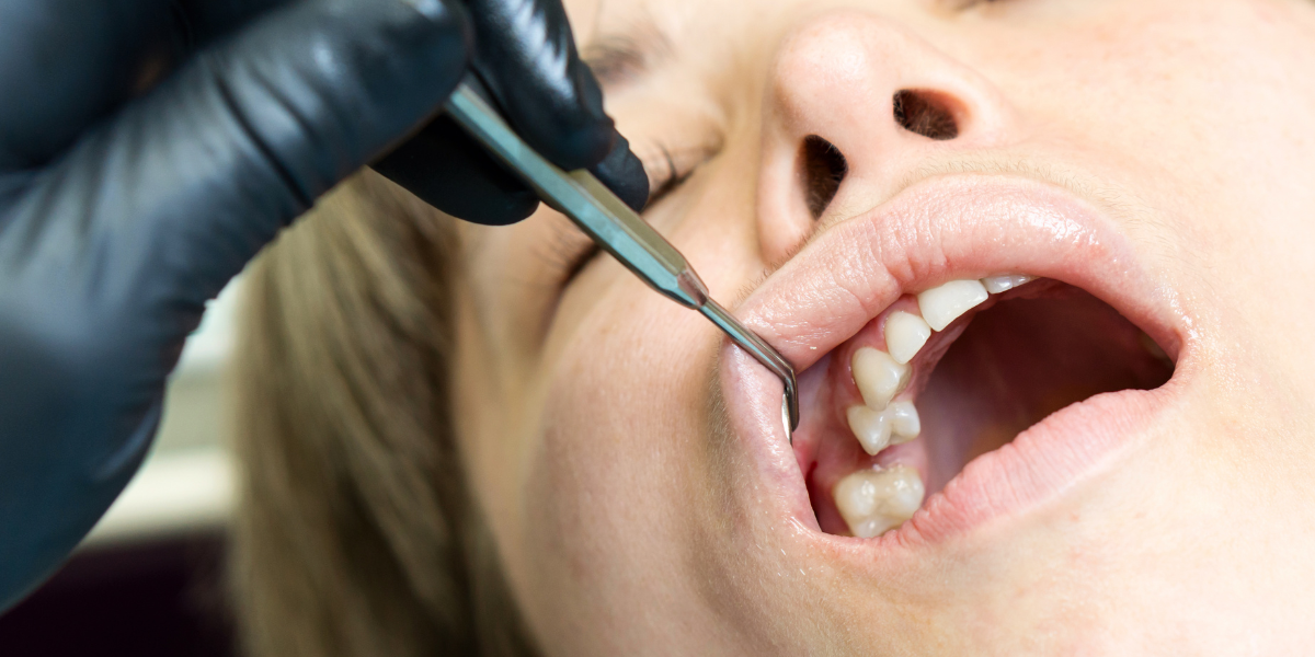 What Happens If an Underbite or Crossbite Is Left Untreated?