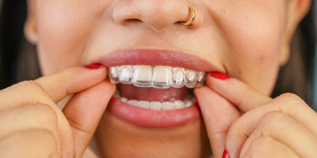 How Long Does Invisalign Take for an Underbite or Crossbite?