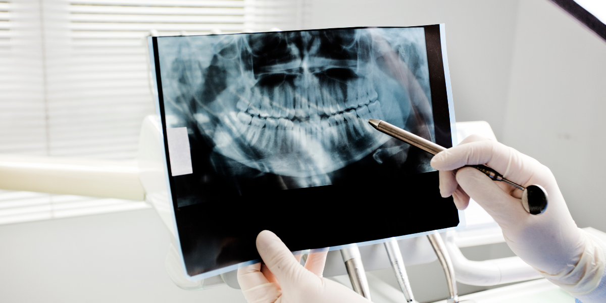 Invisalign Before or After a Dental Implant? The Treatment Order Can Change the Final Result